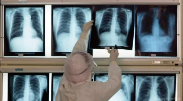 Есть ли противопоказания для проведения флюорографии лёгких?